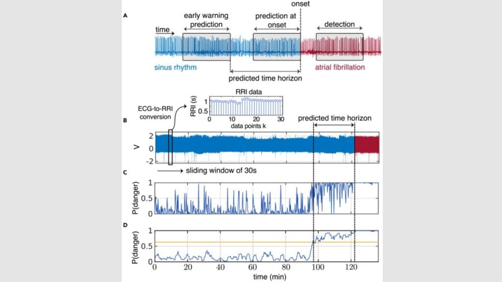 Study uses heart data and AI to predict AFib onset 30 minutes before it happens photo 2
