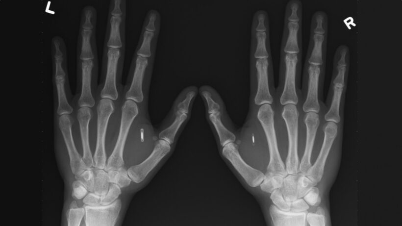 The biohacking scene is gearing up for next-gen implants