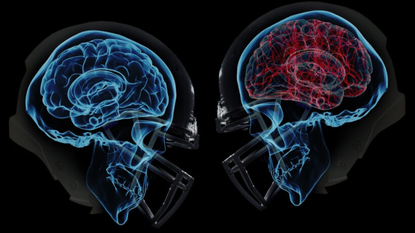 Both on and off the field, wearables are taking on the NFL’s concussion crisis