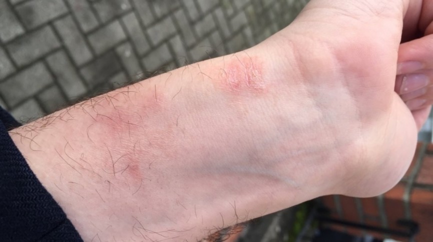 What you need to know about these Apple Watch skin irritation complaints