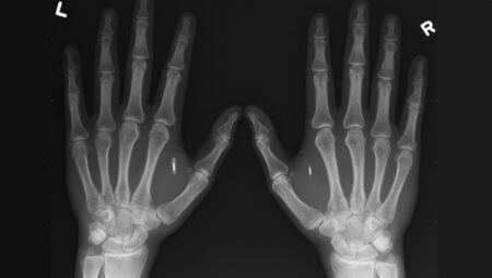 US presidential candidate gets RFID/NFC chip implanted in his hand