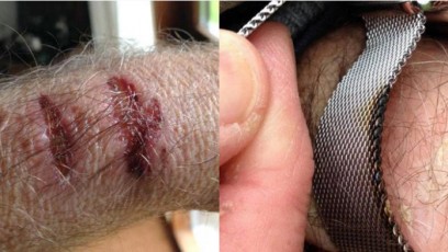 What you need to know about these Apple Watch skin irritation complaints