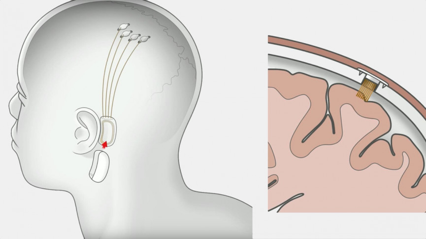 Neuralink guide: How wearables will play their part in Elon Musk's brain tech